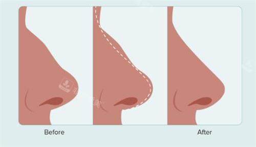 济南诺德医疗美容医院鼻子整形图