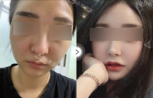 韩国UcanB整形外科鼻整形照片