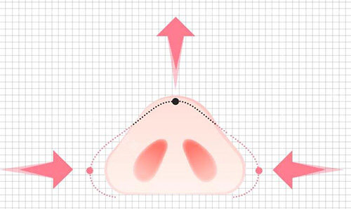 鼻翼缩小改善卡通图