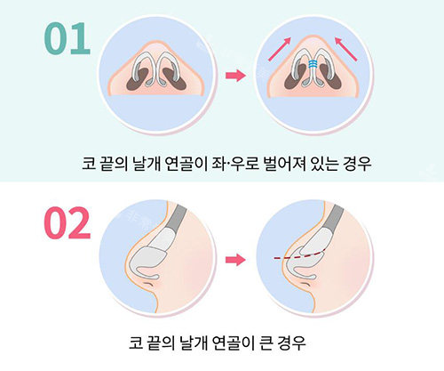 隆鼻改善治療展示圖照片