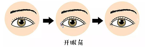 開眼角卡通展示圖 開眼角卡通展示圖