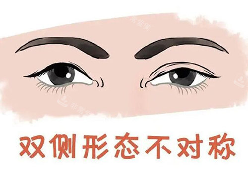 雙眼皮左右形態(tài)不對稱 雙眼皮左右形態(tài)不對稱