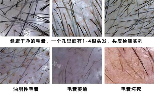 健康毛囊和非健康毛囊示意图