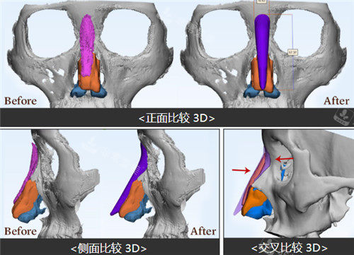 3D打印隆鼻技術(shù)照片
