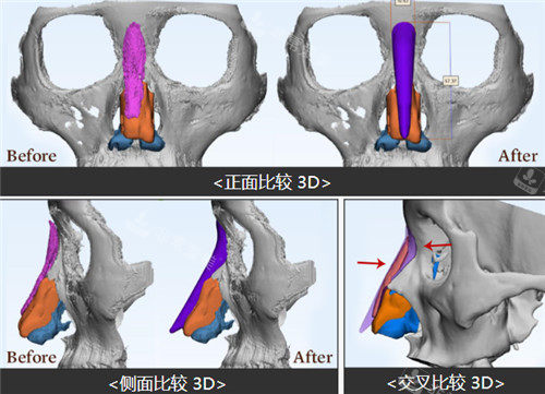 3D打印隆鼻技术照片