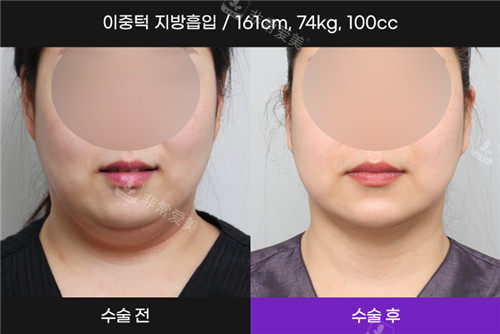 韩国N-Slim吸脂医院吸脂前后照片