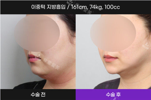 韩国N-Slim吸脂医院面吸术后照片