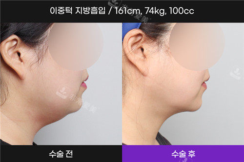 韩国N-Slim吸脂医院吸脂手术照片