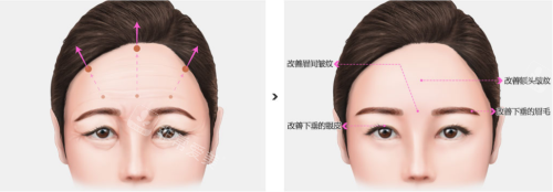 韩国贝缇莱茵整形医院额头拉皮成效