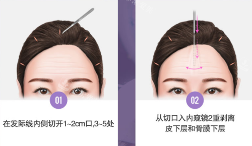 韩国贝缇莱茵整形医院额头迷你拉皮手术方法前两步