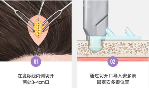 韩国贝缇莱茵整形医院额头拉皮手术方法