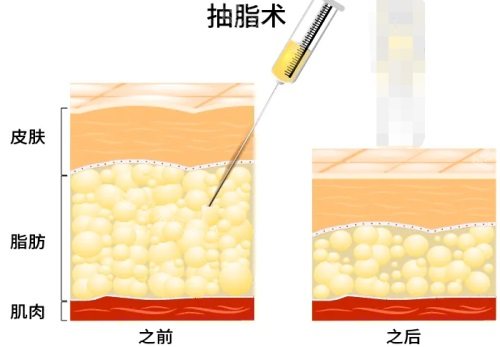 吸脂前后脂肪對比圖