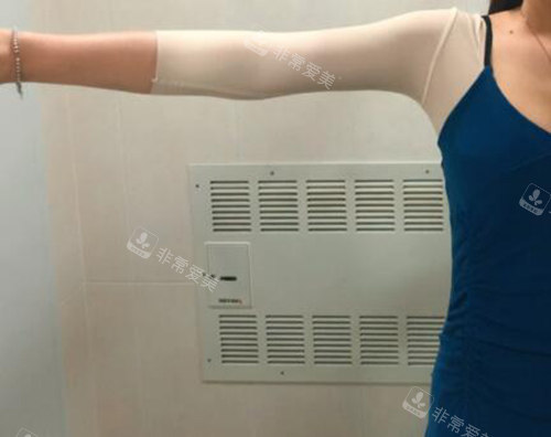 韩国365mc医院手臂吸脂恢复过程图