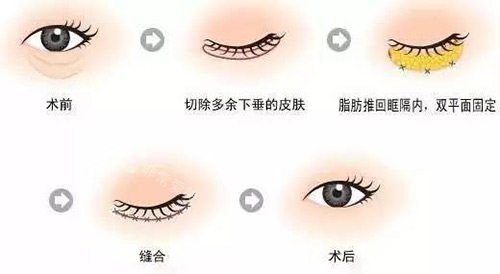 眼睛整形改善治療展示 眼睛整形改善治療展示