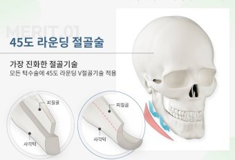 韩国绮林整形医院45度旋转截骨术示意图