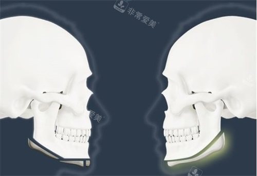 下颌角整形截骨对比示意图