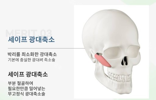 韩国绮林整形医院颧骨整形示意图