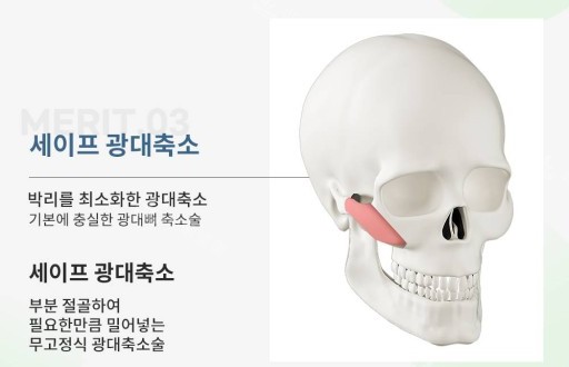韓國綺林整形醫(yī)院顴骨整形示意圖 韓國綺林整形醫(yī)院顴骨整形示意圖