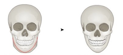 轮廓整形下颌角手术对比漫画图