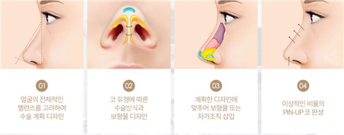韩国noselip整形外科鼻整形动画图示