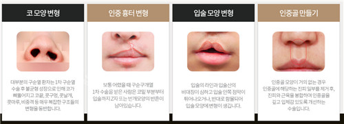 唇腭裂修复手术适应症