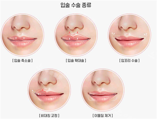 韩国noselip整形外科唇部整形适应症