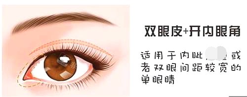 青島諾美德整形醫(yī)院眼部整形圖 青島諾美德整形醫(yī)院眼部整形圖