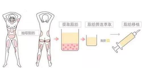 揭秘:韩国芙莱思整形医院自体脂肪移植隆胸水平怎么样?
