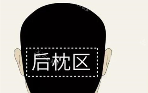 植發(fā)取法部位示意圖 植發(fā)取法部位示意圖