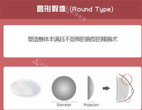 圆形丰胸假体示意图