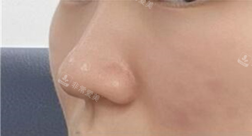 韩国WILL整形外科隆鼻术前图