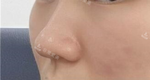 韓國(guó)WILL整形外科隆鼻術(shù)前圖
