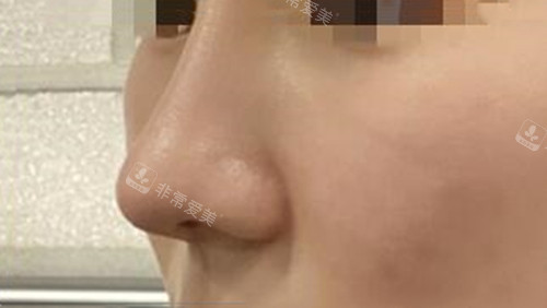 韩国WILL整形外科鼻整形术后图