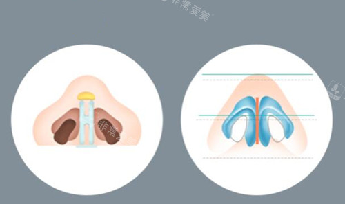 鼻子整形操作过程示意图