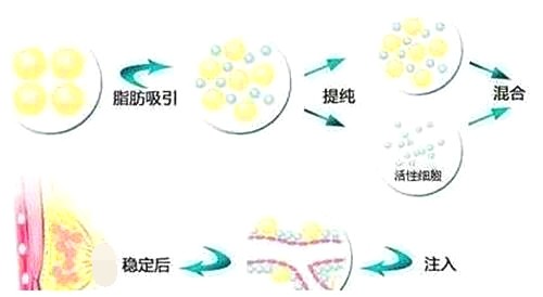 自体脂肪提取示意图