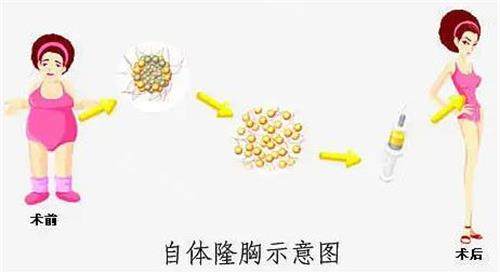 自體脂肪隆胸示意圖 自體脂肪隆胸示意圖