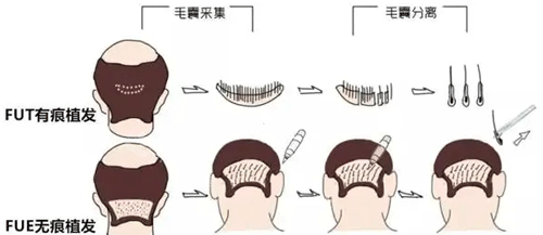 植發(fā)步驟圖