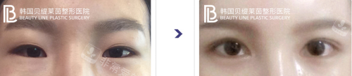 韩国贝缇莱茵整形医院双眼皮修复前后对比