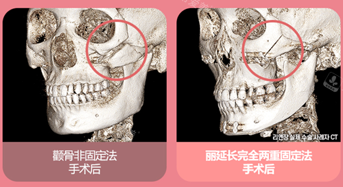 韓國(guó)麗延長(zhǎng)顴骨手術(shù)雙重固定法圖示