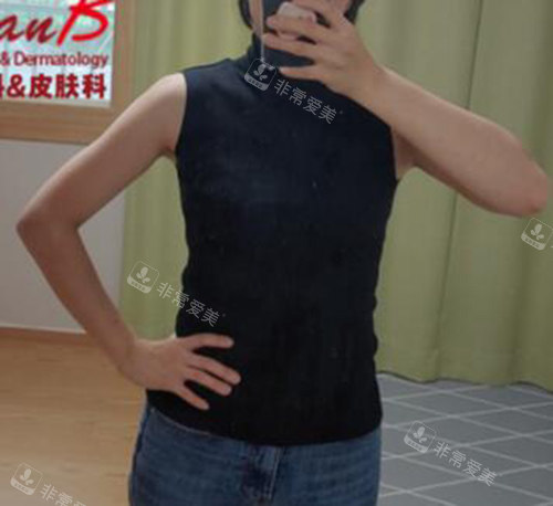 韓國(guó)UcanB整形外科手臂吸脂八周照片