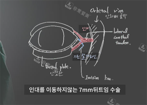 韩国绮林整形医院7mm开眼角手术示意图