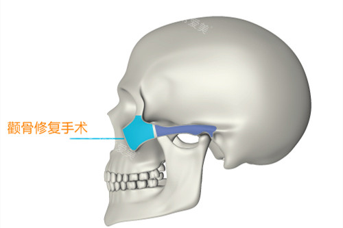 颧骨修复手术示意图