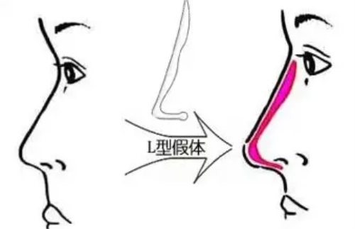 韩国宝士丽鼻整形技术好不好？隆鼻鼻修复都比较擅长！