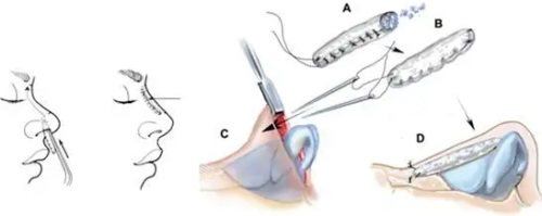 隆鼻缝合过程示意图