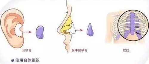 韩国宝士丽鼻整形技术好不好？隆鼻鼻修复都比较擅长！