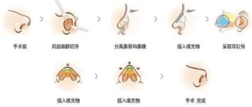 隆鼻詳細(xì)過程示意圖