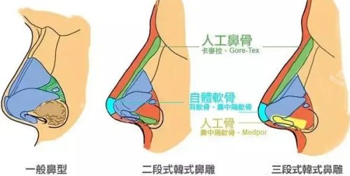 三種鼻型對(duì)比圖