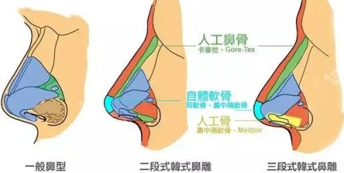 三种鼻型对比图