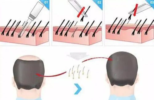 植發(fā)種植毛囊示意圖