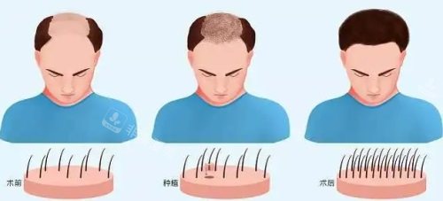 種植毛囊過(guò)程圖